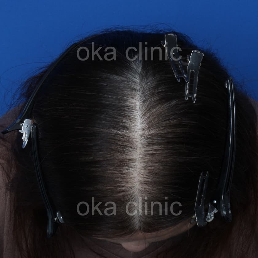 頭頂 サイドの治療後の画像