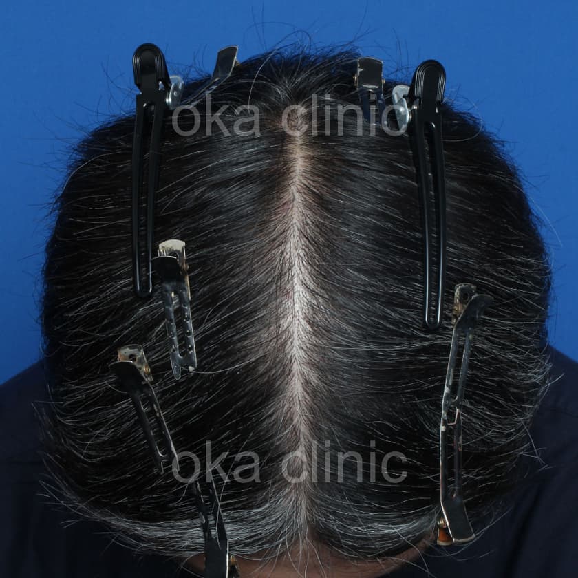 頭頂の治療後の画像