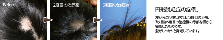 円形脱毛症の治療例。5度目の治療後には髪がしっかりと発毛しています。