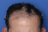 50代男性生え際の薄毛症例写真