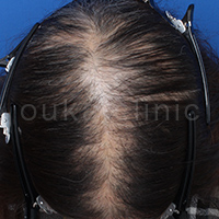 女性の薄毛頭頂部症例写真