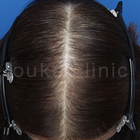 H-non治療後の女性頭頂部症例写真