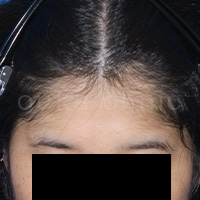 30代女性生え際の薄毛症例写真
