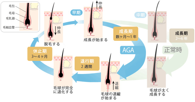 AGA発症後の毛周期